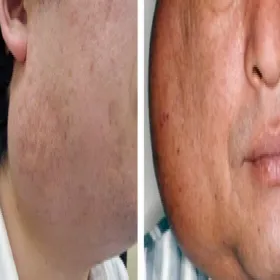 Obrzęk twarzy choroba Kimury