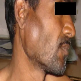 Obrzęk w okolicy ślinianki przyusznej lub podżuchwowej choroba Kimury