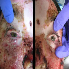 Oczy choroba zespół Stevensa- Johnsona 