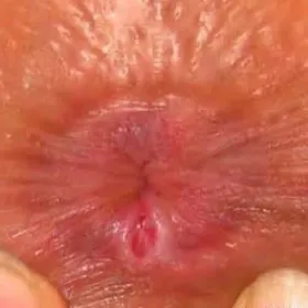 Odbytnica choroby szczelina odbytu 