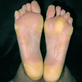 Odcisk wewnętrzny na stopie