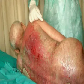 Odleżyny u osób obłożnie chorych