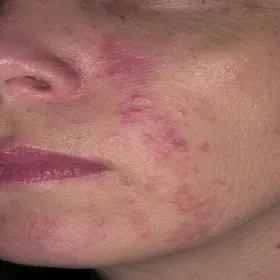 Okołoustne zapalenie skóry