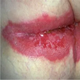 Okolice odbytu czerwone pozasutkowa choroba Pageta 