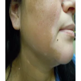 Okrągłe owalne plamy depigmentacyjne