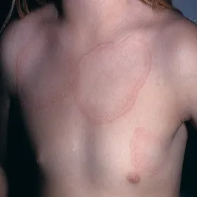 Okrągłe plamy na klatce piersiowej ziarniniak obrączkowaty 