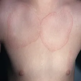 Okrągłe plamy na skórze ziarniniak obrączkowaty 