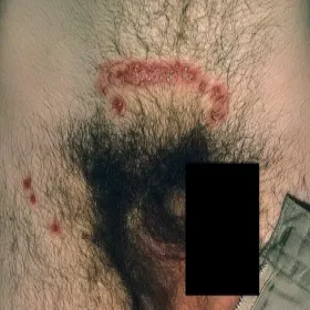 Opryszczka miejsc intymnych