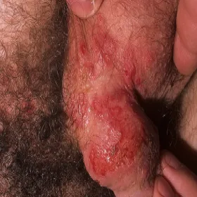 Opryszczka na mosznie