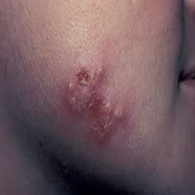 Opryszczka u dziecka