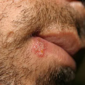 Opryszczka u mężczyzny na wardze