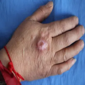 Opuchnięcie i siniak po ukłuciu kolcem róży sporotrychoza 