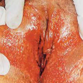 Opuchnięte wejście do pochwy choroba chlamydia