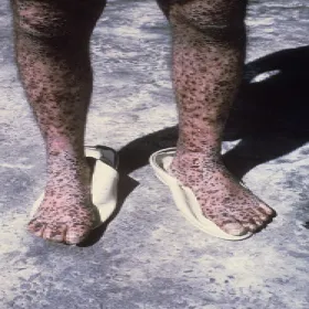 Ospa prawdziwa zdjęcie