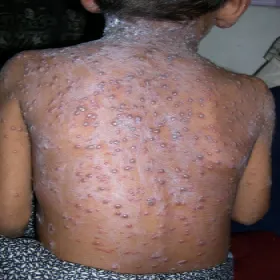 Ospa wietrzna objawy