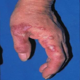 Ostra gorączkowa dermatoza neutrofilowa 