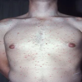 Ostra postać przyłuszczycy