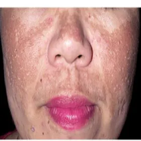 Ostuda nad górną wargą