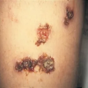 Owrzodzenia z uniesionym brzegiem ecthyma 