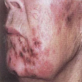 Półpasiec na twarzy