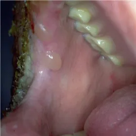 Pęcherz w jamie ustnej