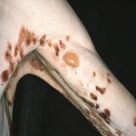 Pęcherze na rękach pemfigoid pęcherzowy