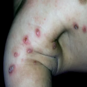 Pęcherze na skórze świerzb u dziecka