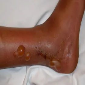 Pęcherze na skórze liszajec