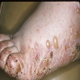 Pęcherze wypełnione płynem na stopach