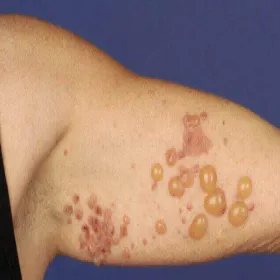 Pęcherzowy rumień wielopostaciowy