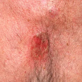 Pęcherzyca miejsc intymnych