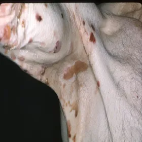 Pęcherzyca pemfigoid pęcherzowy