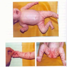 Pęcherzyca syfilityczna