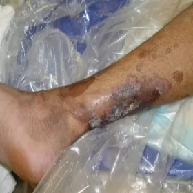 Pęcherzyca zwykła na nodze