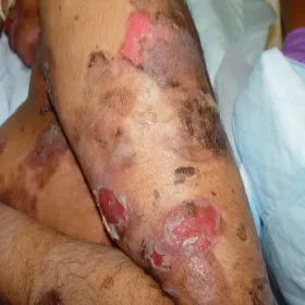 Pęcherzyca zwykła na rękach