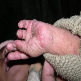 Pęcherzyki na dłoniach rękach u dziecka świerzb