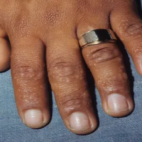 Pęcherzyki na dłoniach wyprysk potnicowy