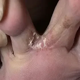 Pękająca skóra między palcami u nóg stopa sportowca