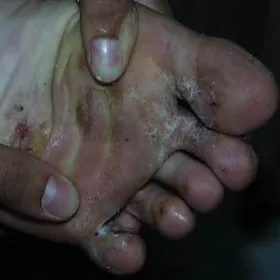 Pękająca skóra pod palcami u nóg stopa sportowca 