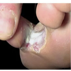 Pęknięcia między palcami u nóg stopa sportowca 