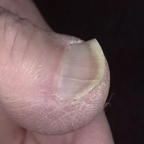 Paznokcie łyżeczkowate