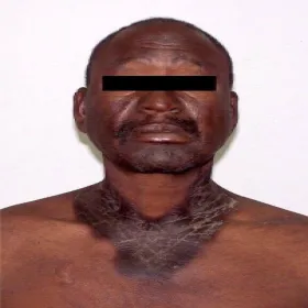 Pelagra choroba zdjęcie