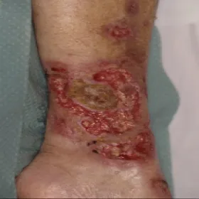 Piodermia zgorzelinowa na nodze