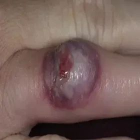 Zgorzelinowe zapalenie skóry palca
