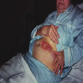 Piodermia zgorzelinowa na skórze brzucha