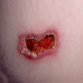 Piodermia zgorzelinowa na skórze