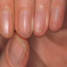 Pionowa biała kreska na paznokciu