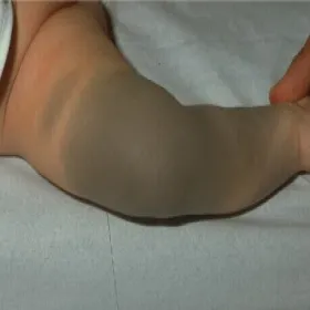 Plama na nodze u dziecka