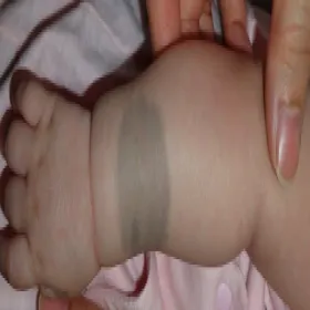 Plama na dłoni u dziecka