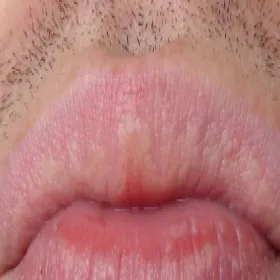 Plamki Fordyce'a na ustach